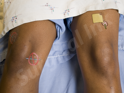 Surgical Ink Don't Cut Knees